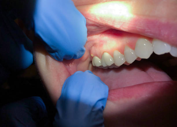 Best Broken or Cracked Tooth Emergency Dentist in Owenton, KY